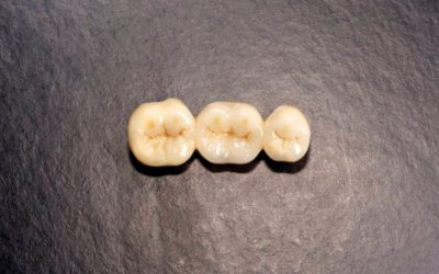 Implant dentar și Coroane dentare Zirconiu