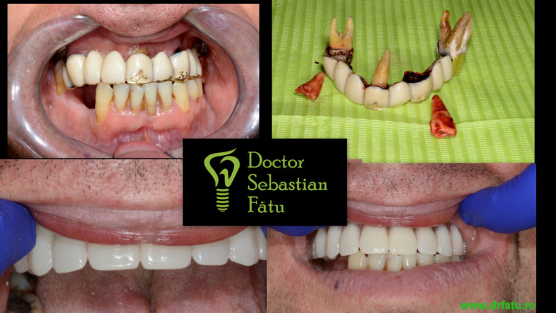 Implant Dentar Rapid – Dantură fixă într-o zi