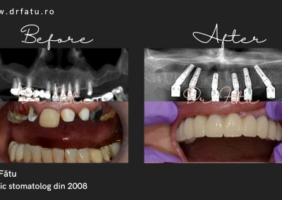 implant-dentar-rapid-3-1