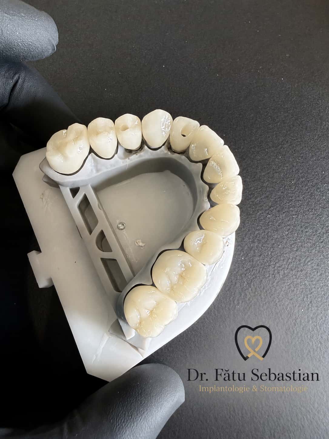 Coroane din zirconiu fixate pe implanturi dentare