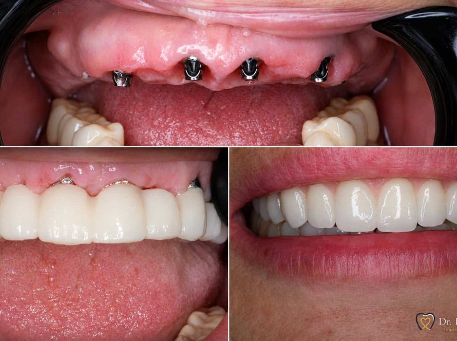 Lucrare provizorie și lucrare definitivă pe implanturi dentare – caz clinic Dr. Fătu