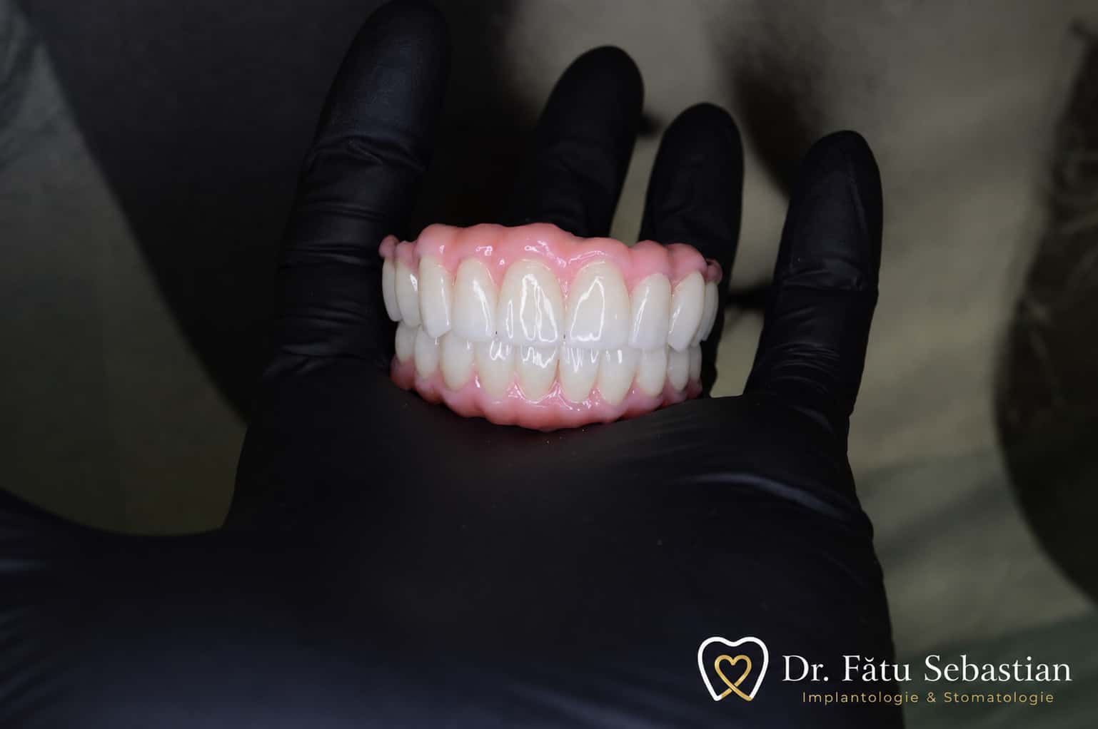 Proteză dentară fixă realizată pentru restaurarea unei arcade