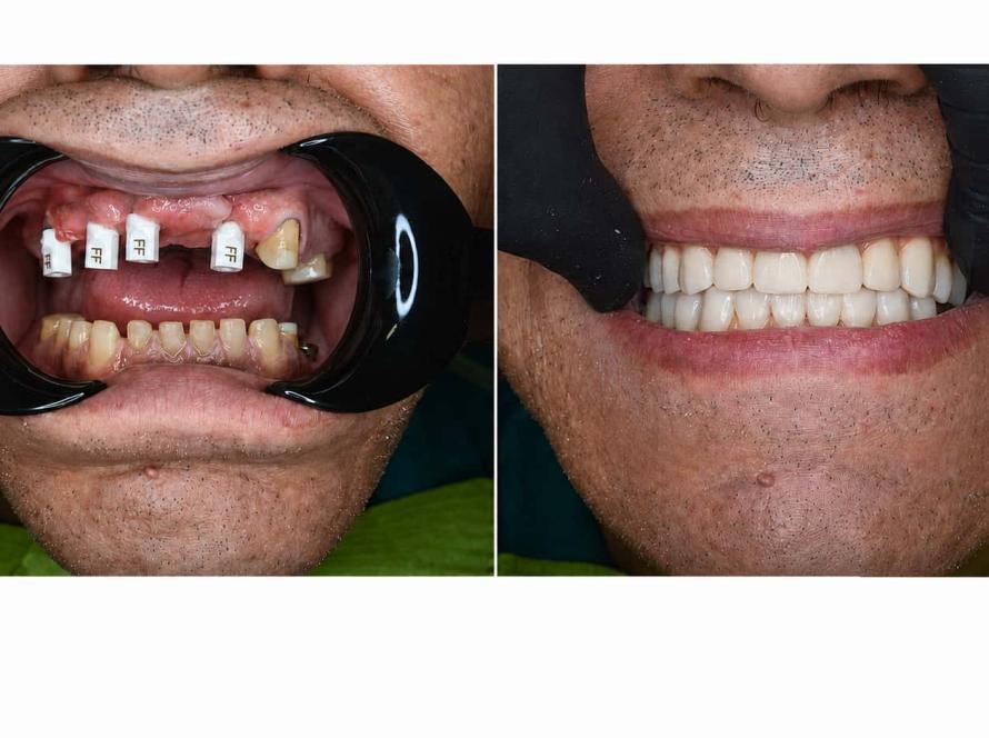 Caz clinic înainte și după cu dantură fixă completă pe implanturi – Dr. Fătu