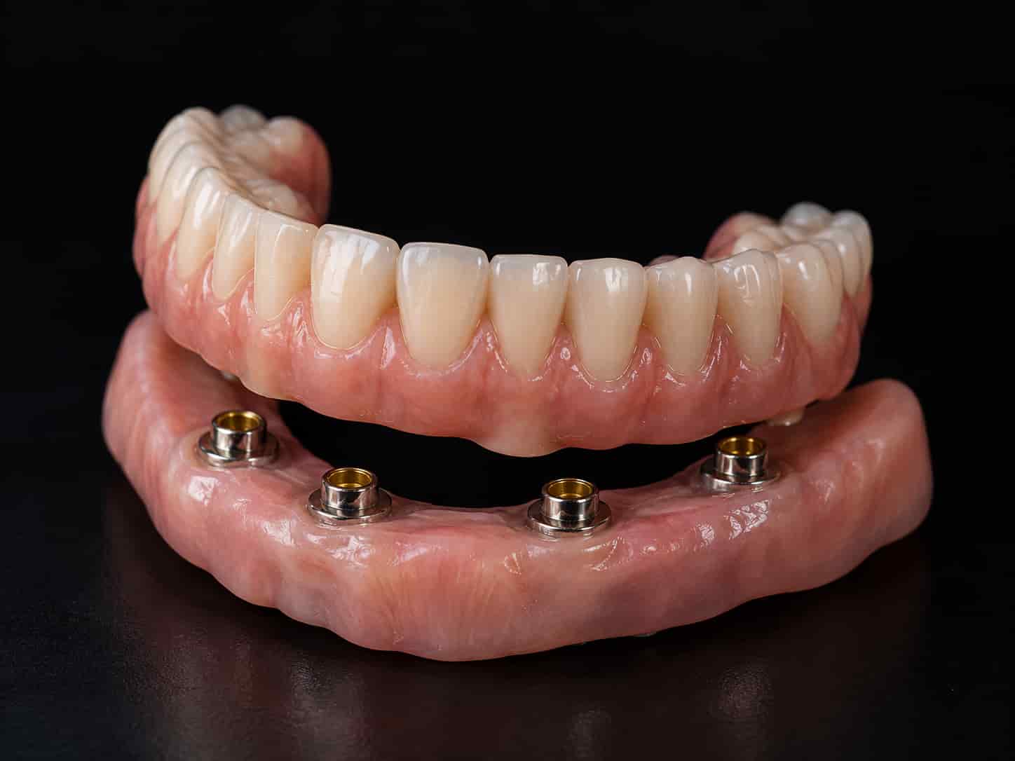 Supraproteză dentară mobilă ancorată pe implanturi