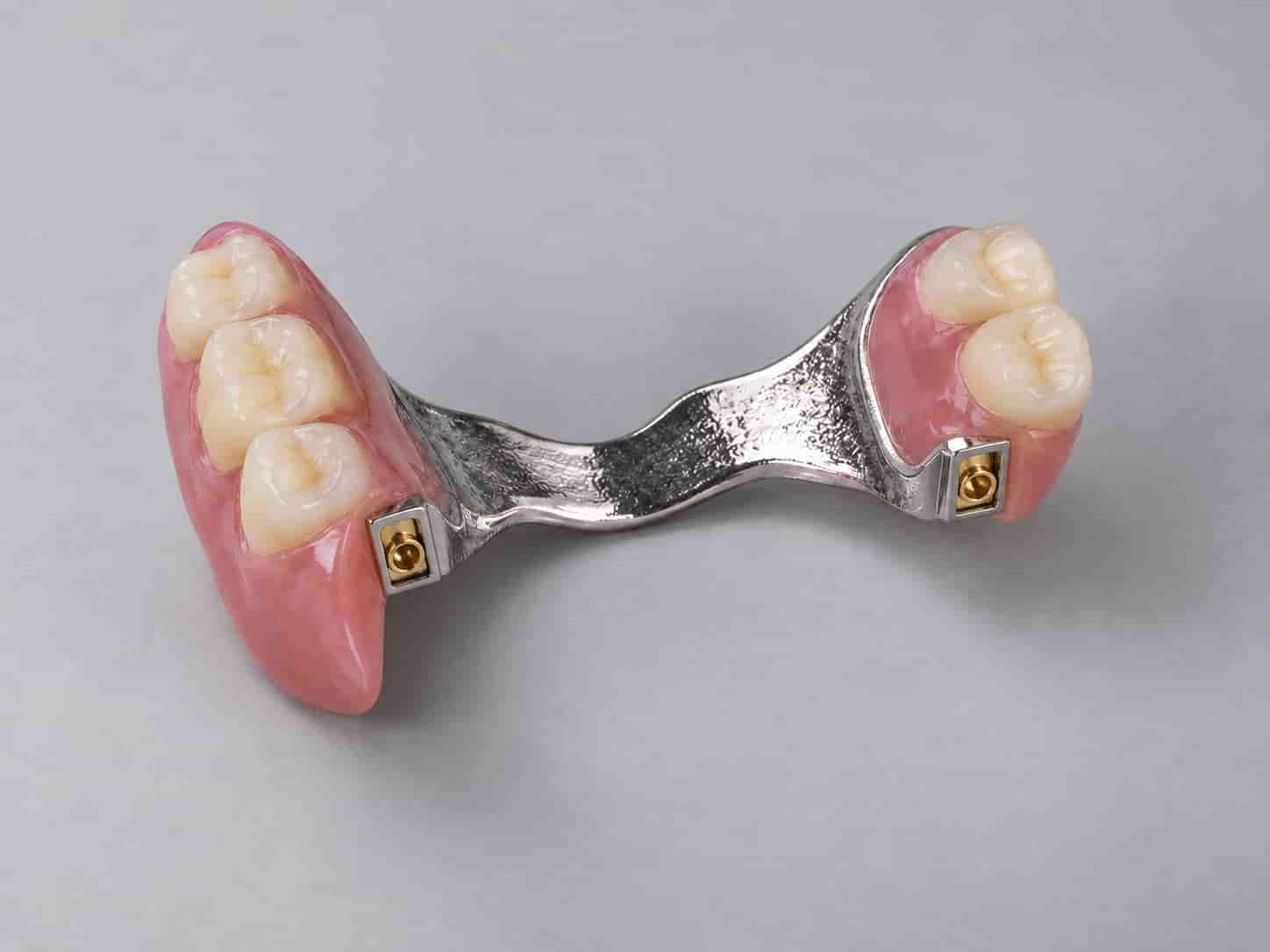 Proteză dentară scheletată cu structură metalică